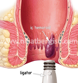 Hemoroid Tedavisi